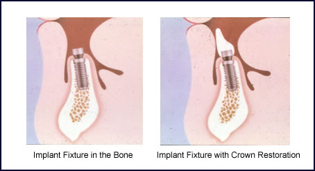 Dental Implants in Scarsdale NY, Westchester County
