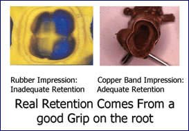 Crown and Bridgework in Scarsdale NY, Westchester County | copper-band-impressions