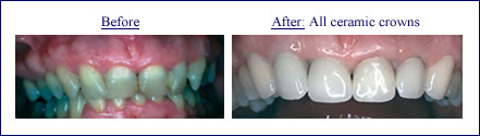 Crown and Bridgework in Scarsdale NY, Westchester County | ceramic-crowns