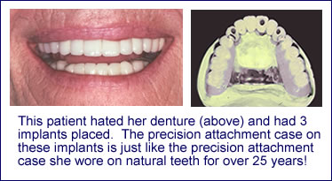 dentures-6