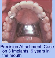 implant-supportive-precision-attachment