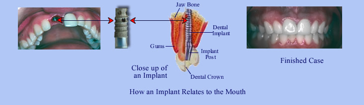 implant_crown_bridge_diagram2