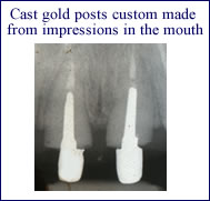 posts-root-canal
