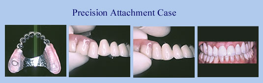Precision Attachment Partial Dentures in Scarsdale NY, Westchester County