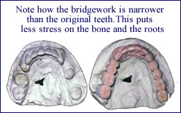 Crown and Bridgework in Scarsdale NY, Westchester County | preventing-periodontal-disease