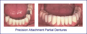 Precision Attachment Partial Dentures