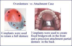 implants-partial-denture