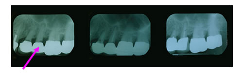 Dental X-Rays in  Scarsdale NY, Westchester County