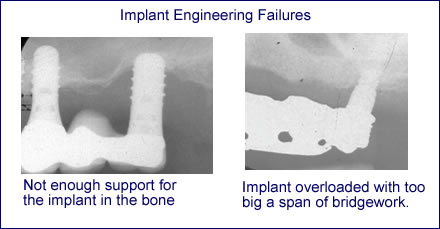 implant-restoration2