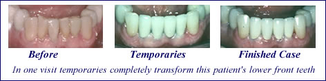 Crown and Bridgework in Scarsdale NY, Westchester County | temporary crowns