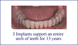 Precision-Attachment-Case-on-Implants