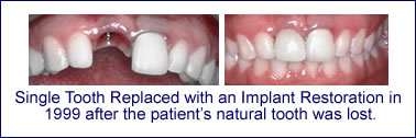 Implant Restorations in Scarsdale NY, Westchester County